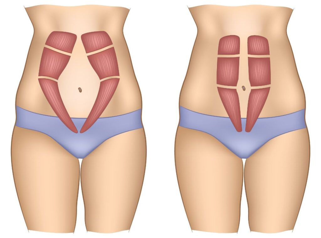 diástase abdominal